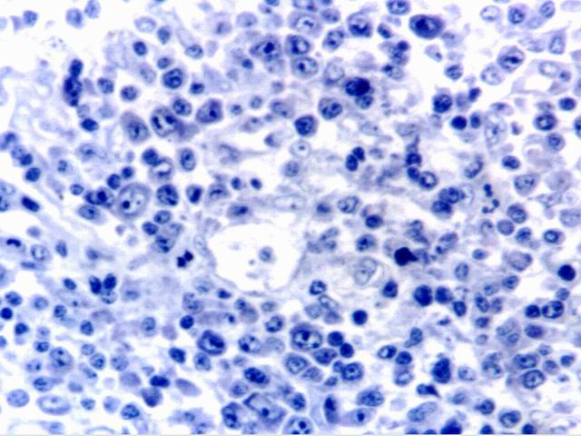 Fig.7: TCRBCL-Giemsa - <div style=